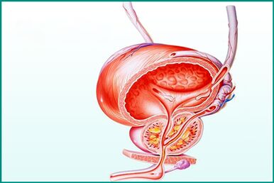 Ontsteking van de prostaat bij acute prostatitis is een beperking voor seks