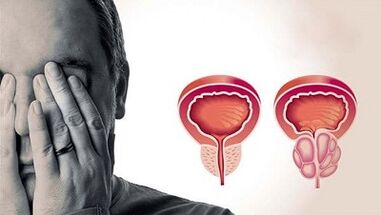 De redenen voor de ontwikkeling van prostatitis bij mannen