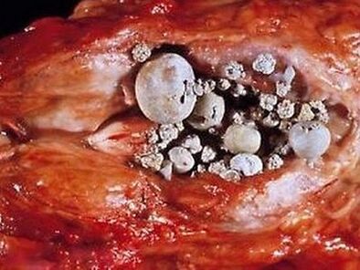 Stenen in de prostaatklier met ernstige prostatitis