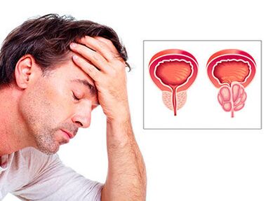 Symptomen van prostatitis maken een man zorgen